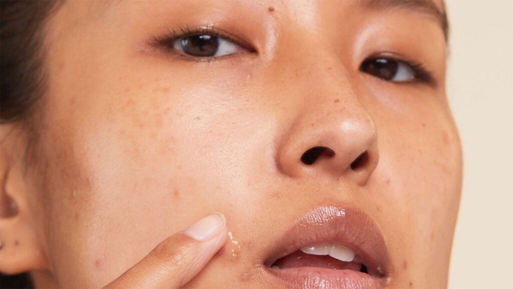 acne
