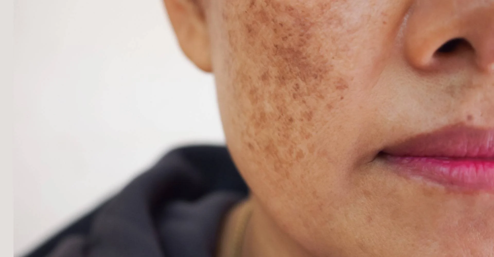 como-tratar-melasma