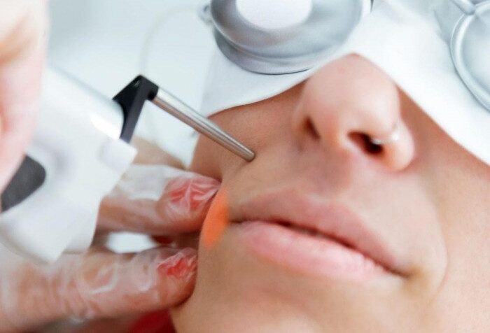 resurfacing-laser