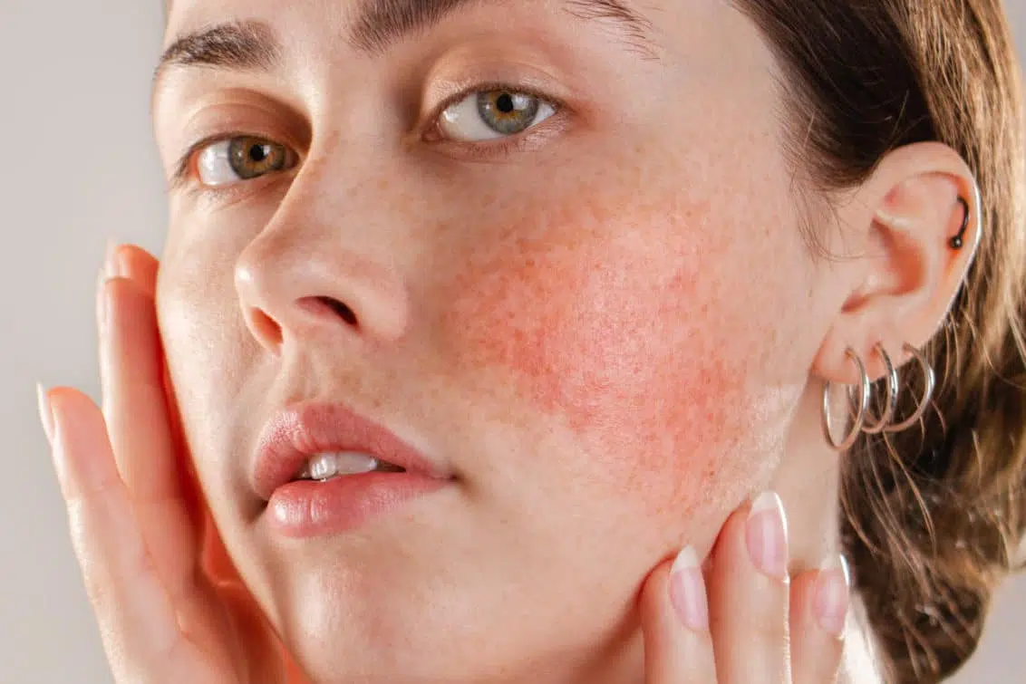 rosacea