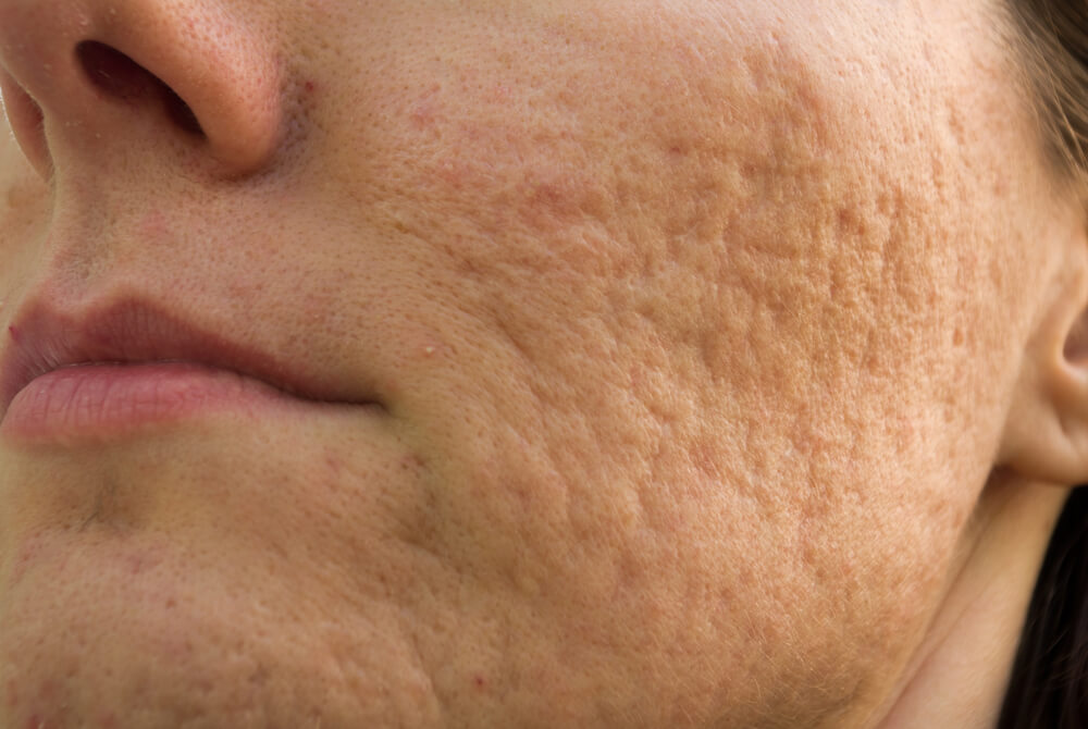 tratamento-acne (2)