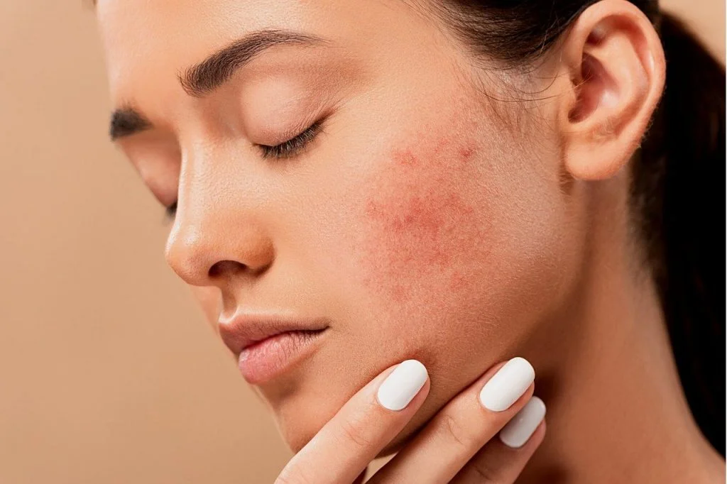 tratamento-acne