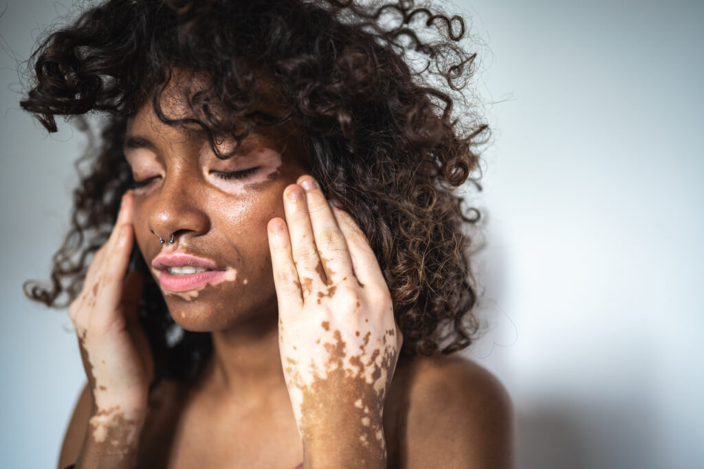 vitiligo
