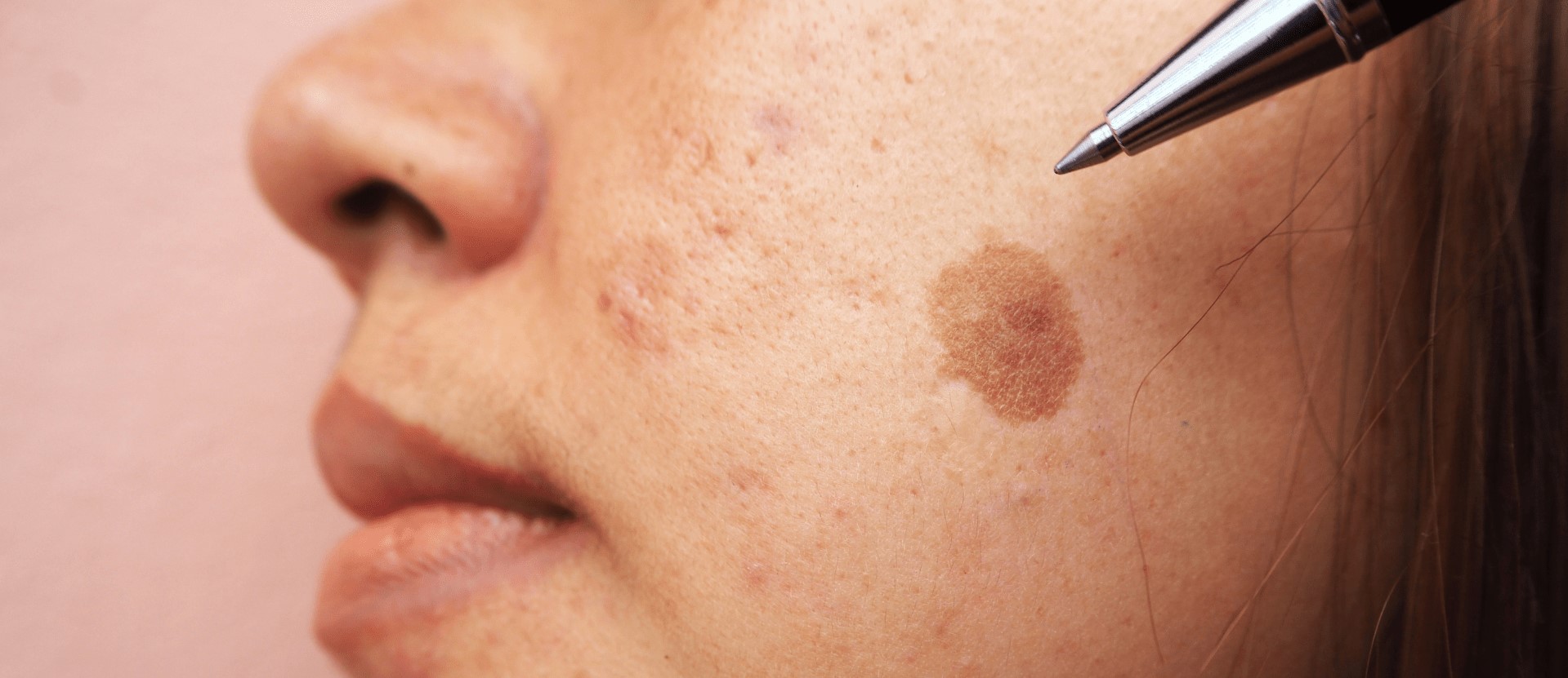 tratamento-melasma-min