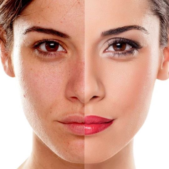 harmonizaçao-facial-preço