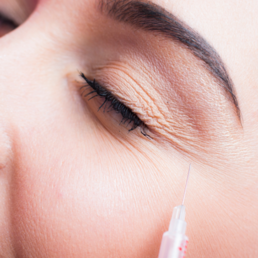 botox-pes-de-galinha-preco