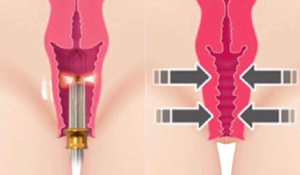 rejuvenescimento-intimo-feminino-laser