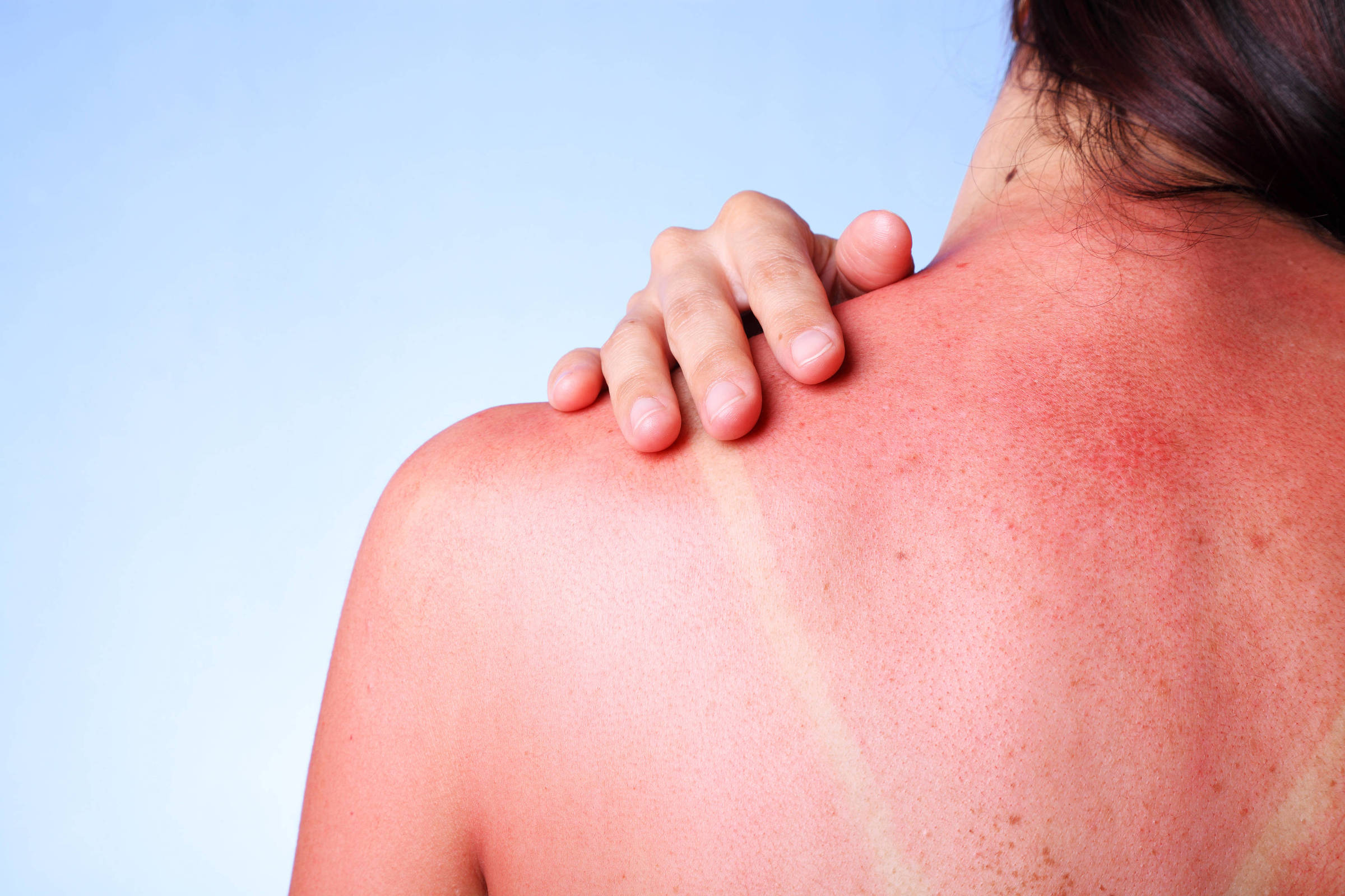 excesso-de-sol