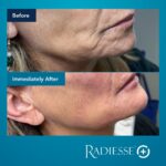 Antes-e-depois-Radiesse-Fotos