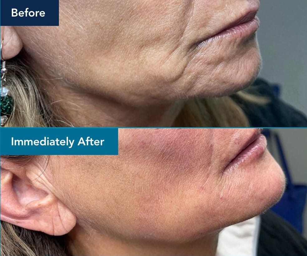 radiesse-antes-e-depois-foto