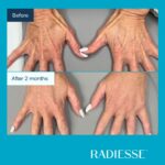 Antes e depois Radiesse Fotos