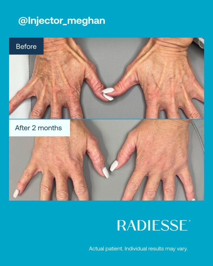 Antes e depois Radiesse Fotos