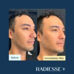 Antes-e-depois-Radiesse-Fotos