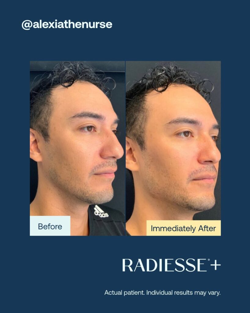 Antes-e-depois-Radiesse-Fotos
