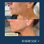 Antes-e-depois-Radiesse-Fotos