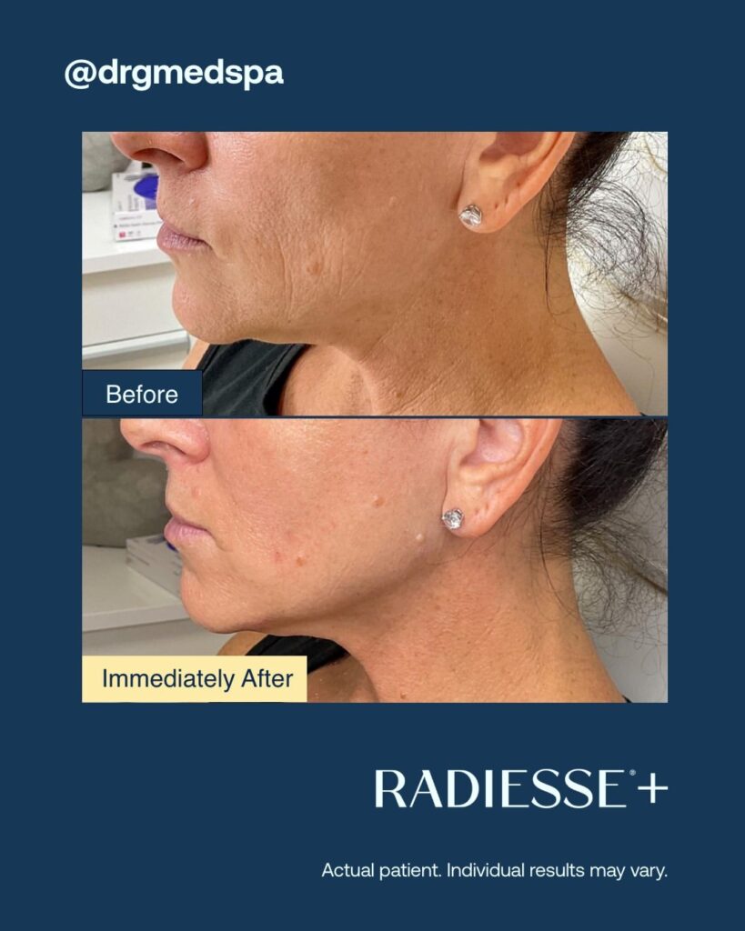 Antes-e-depois-Radiesse-Fotos