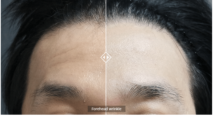 Antes-e-depois-liftera-Fotos