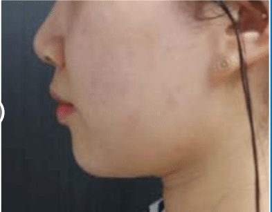 Antes-e-depois-liftera-Fotos