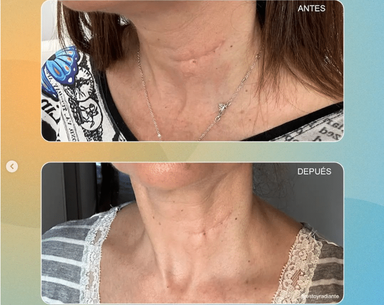 Antes-e-depois-liftera-Fotos