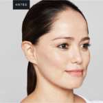 Antes-e-depois-skinbooster-Fotos