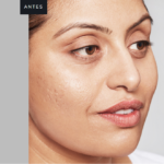 Antes-e-depois-skinbooster-Fotos