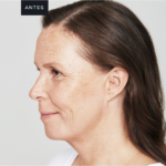 Antes-e-depois-skinbooster-Fotos
