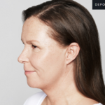 Antes-e-depois-skinbooster-Fotos
