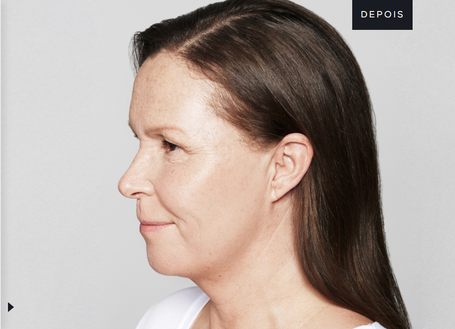 Antes-e-depois-skinbooster-Fotos