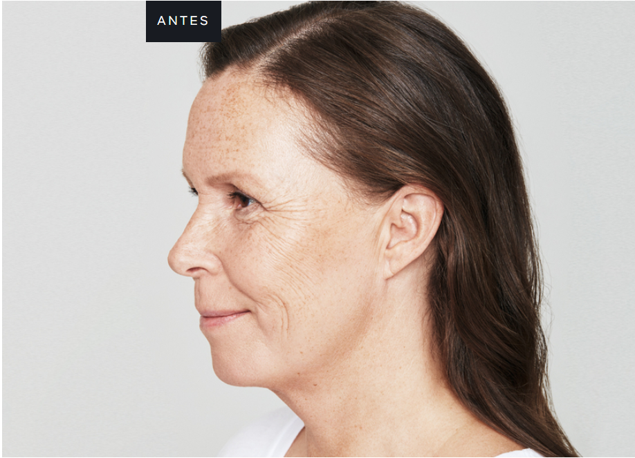 Antes-e-depois-skinbooster-Fotos