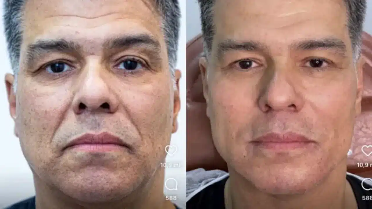 antes-e-depois-harmonizacao-facial-masculina-preco-rj
