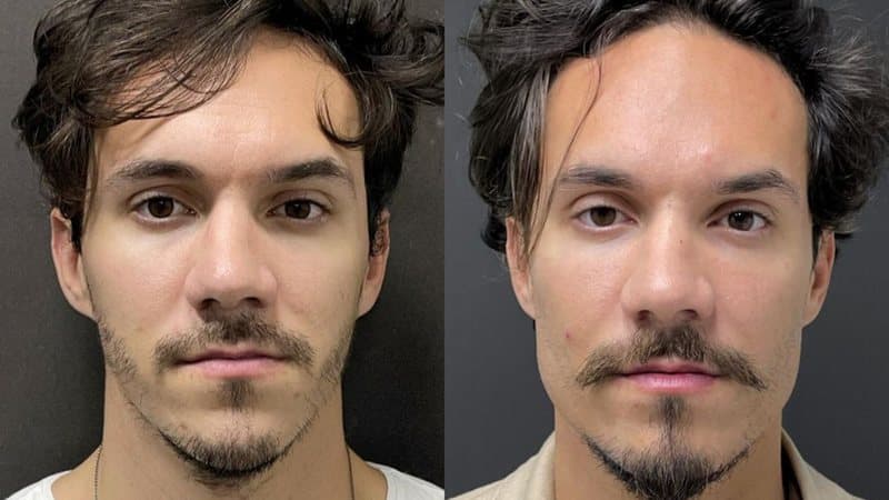 antes-e-depois-harmonizacao-facial-masculina-preco-rj-4