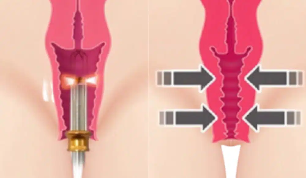 rejuvenescimento-intimo-laser