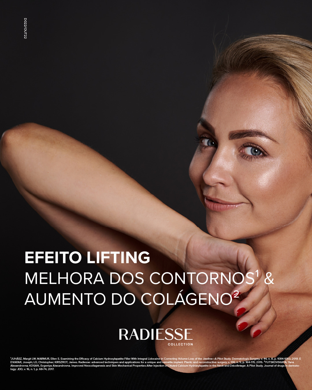 efeito-lifiting-radiesse