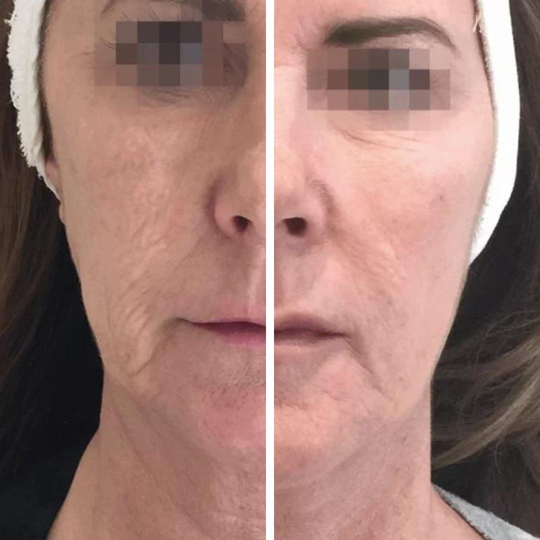 foto-antes-e-depois-profhilo-2