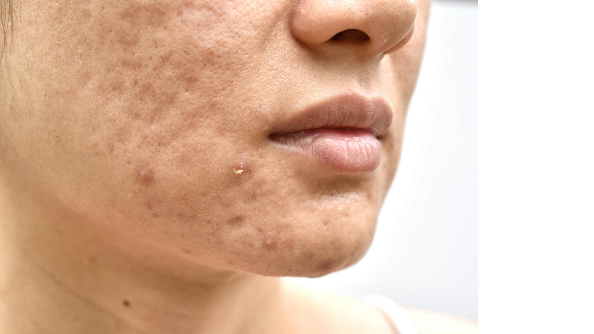 tratamento cicatriz de acne
