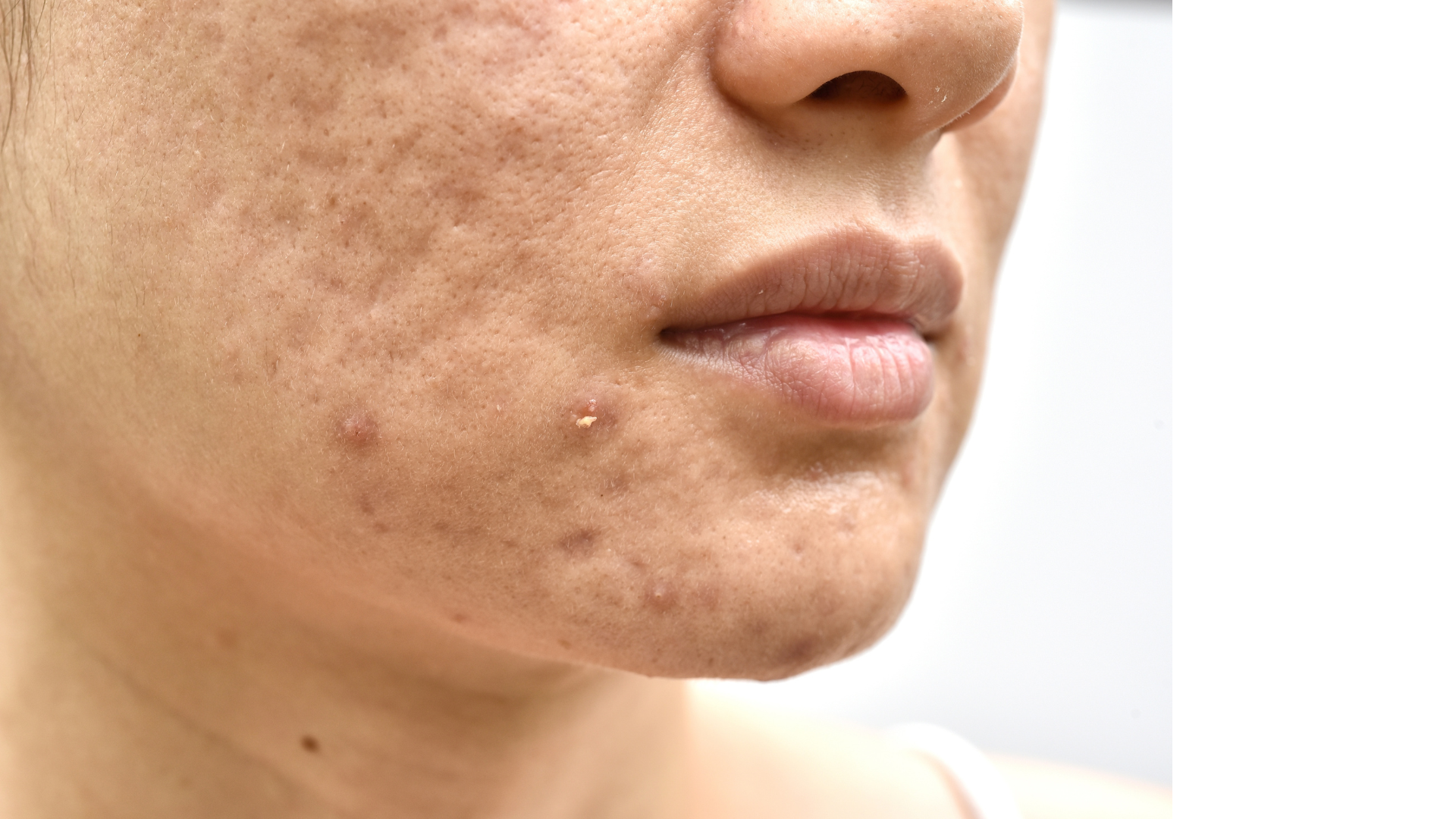 tratamento-cicatriz-de-acne