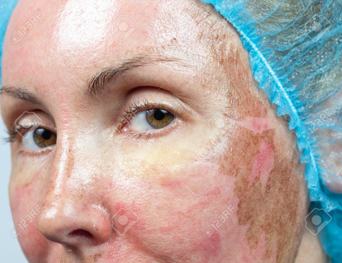peeling-de-fenol