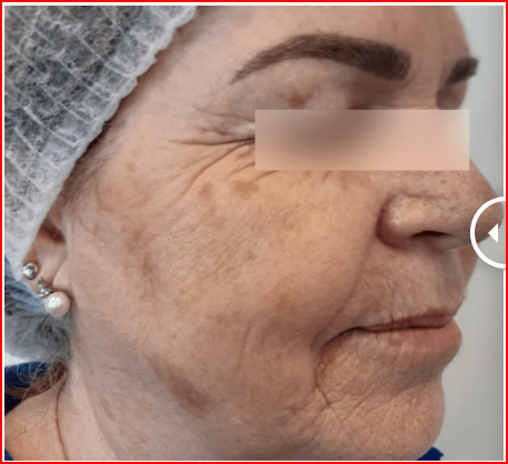 foto-Antes-Laser-para-rugas