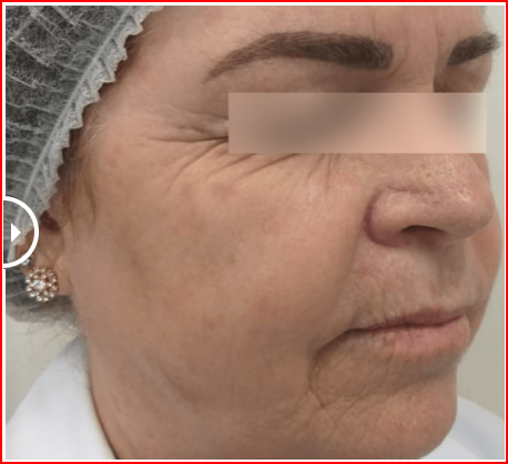 foto-depois-Laser-para-rugas