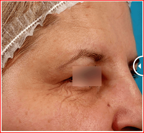 foto-antes-Laser-para-pes-de-galinha