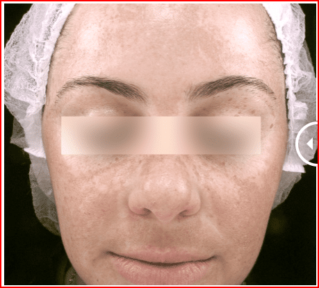 foto-antes-Laser-para-melasma