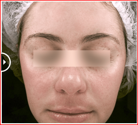 foto-depois-Laser-para-melasma