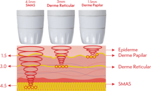 liftera-como-funciona-ultrassom-microfocado-2