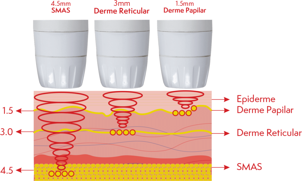 liftera-como-funciona-ultrassom-microfocado-2