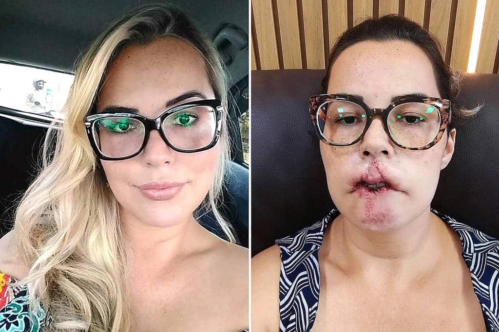 antes-e-depois-pmma