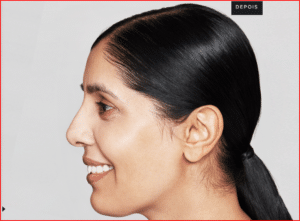 Foto-antes-e-Depois-Preenchimento-Restylane-1