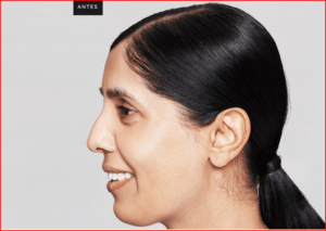 Foto-antes-e-Depois-Preenchimento-Restylane-2
