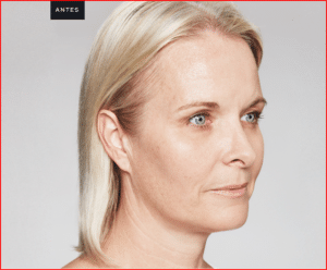 Foto-antes-e-Depois-Preenchimento-Restylane-3