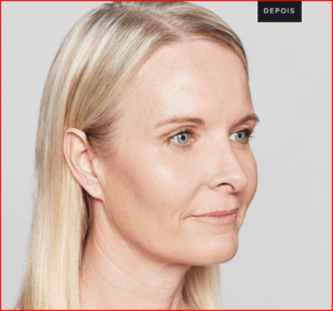 Foto-antes-e-Depois-Preenchimento-Restylane-4