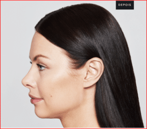 Foto-antes-e-Depois-Preenchimento-Restylane-6